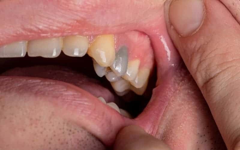 black teeth in adults