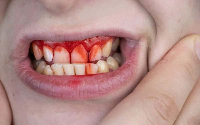 how effective is gum therapy for bleeding gums